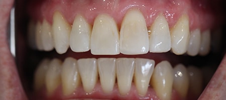 After Invisalign Treatment Reading Smiles