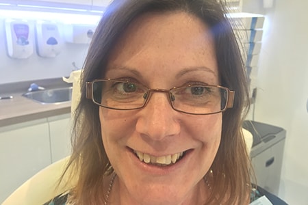 Before Invisalign Treatment Reading Smiles