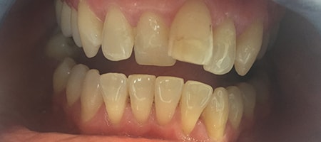 Before Invisalign Treatment Reading Smiles