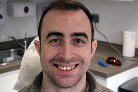 Before Invisalign Treatment Reading Smiles