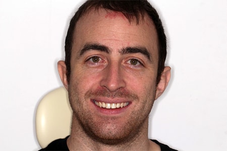 After Invisalign Treatment Reading Smiles