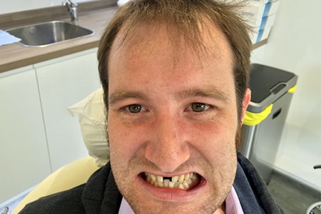 Before Invisalign Treatment Reading Smiles