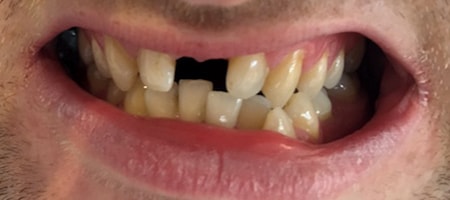 Before Invisalign Treatment Reading Smiles