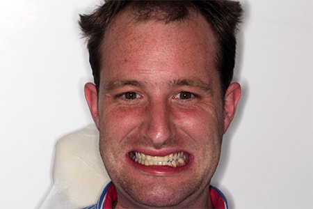 After Invisalign Treatment Reading Smiles