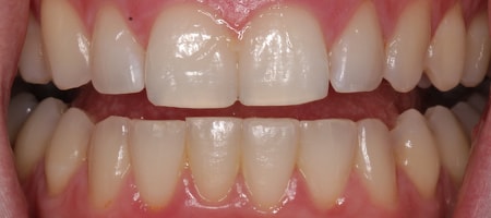 After Invisalign Treatment Reading Smiles