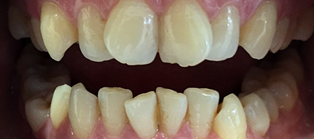 Before Invisalign Treatment Reading Smiles