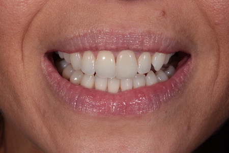 Before and After Invisalign Treatment Windsor Before and After Invisalign Treatment Windsor