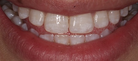 After Invisalign Treatment Reading Smiles
