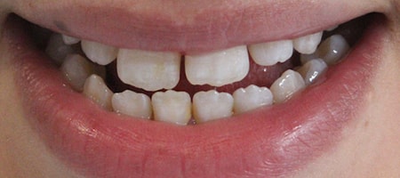 Before Invisalign Treatment Reading Smiles