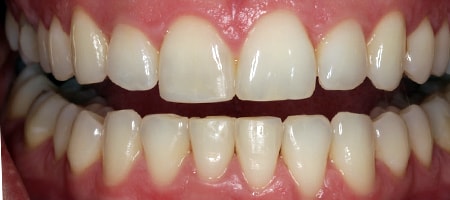 After Invisalign Treatment Reading Smiles