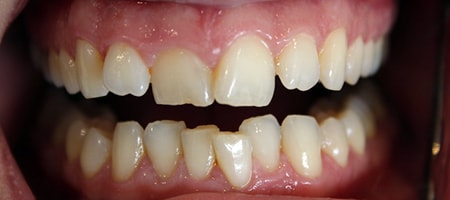 Before Invisalign Treatment Reading Smiles
