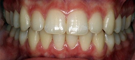 After Invisalign Treatment Reading Smiles