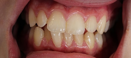 Before Invisalign Treatment Reading Smiles