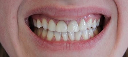 Before and After Invisalign Treatment Windsor Before and After Invisalign Treatment Windsor