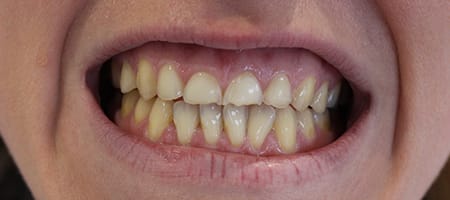 Before and After Invisalign Treatment Windsor Before and After Invisalign Treatment Windsor