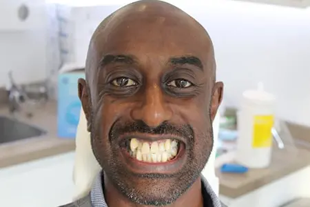 Before and After Invisalign Treatment Kingston Before and After Invisalign Treatment Kingston