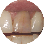 Discoloured teeth