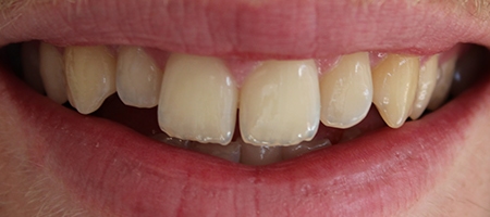 Before Invisalign Treatment at Smile rooms In Windsor