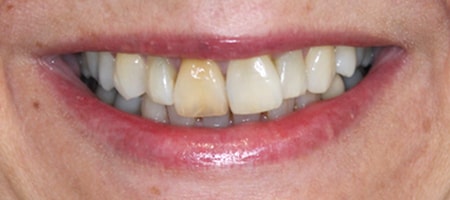 Before cosmetic Treatment Smile Rooms 