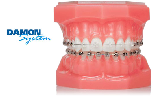 Damon braces Windsor Dentist