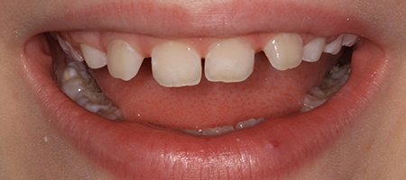 After Invisalign Treatment Reading Smiles 