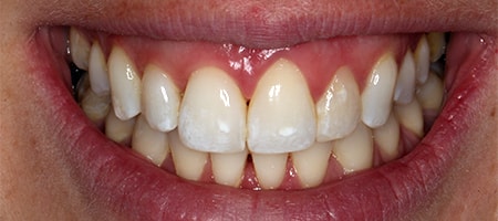 After Invisalign Treatment Reading Smiles 