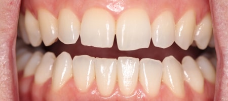 Before Invisalign Treatment Reading Smiles 