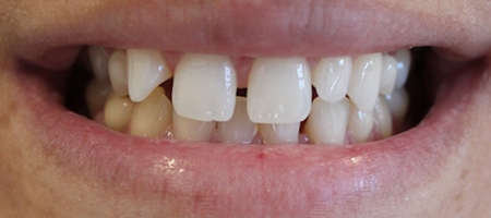 Before Invisalign Treatment Reading Smiles 