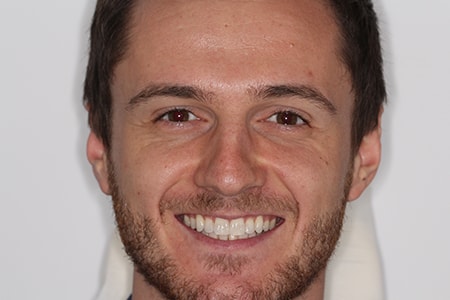 reading-smiles-invisalign-p1-a1-1-1